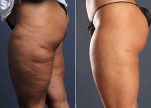 Cellulaze_Cellulite_Reduction__Women_Thighs_Buttocks_Side_Miller_2