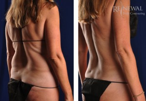 Male Love Handle Liposuction Before & After Photos Charlotte North