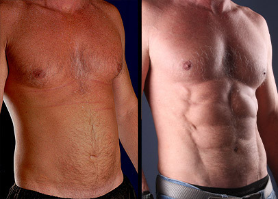 Male Liposuction Before and After