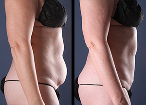 LIPOSUCTION IS AWESOME, BUT HOW FANTASTIC IS IT? - Raleigh Plastic